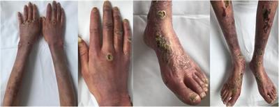 Case report: Antiplatelet therapy on metastatic paraganglioma-associated cutaneous vascular disease and literature review